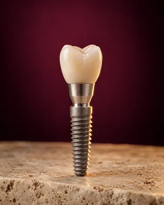 Ilustração de um implante dentário com coroa